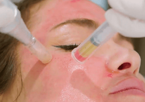 Microneedling w/PRP
