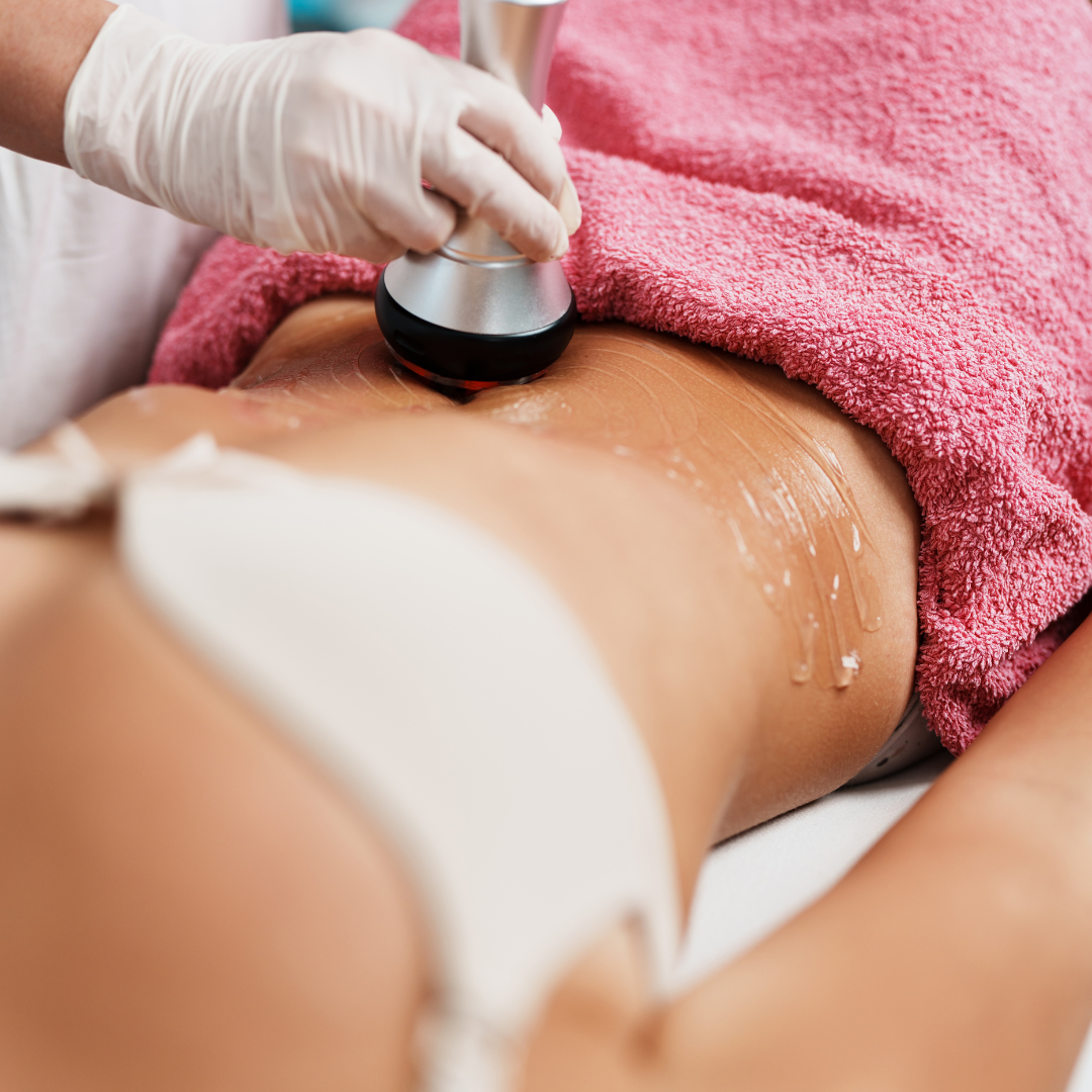 RF Skin Tightening Body Treatment