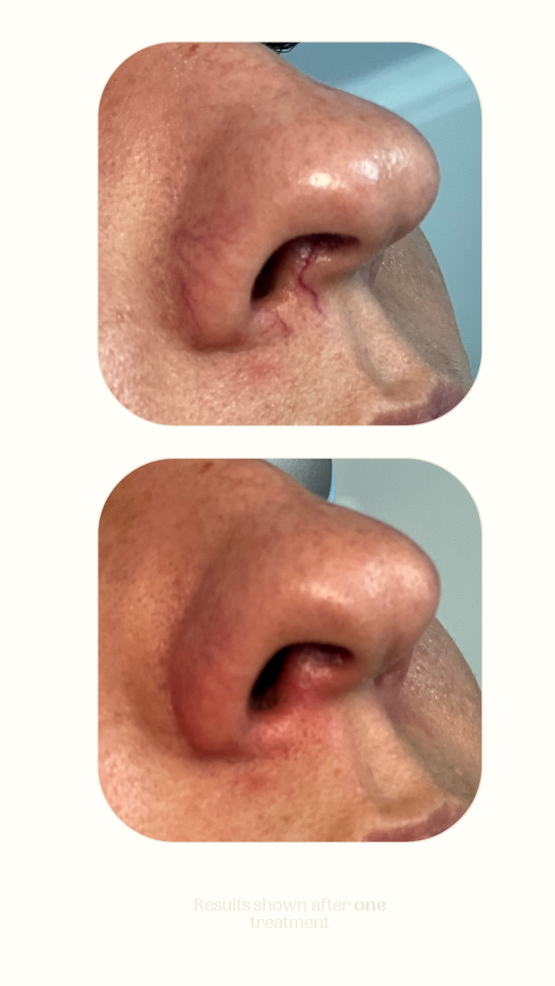 Vascular Lesion Treatment