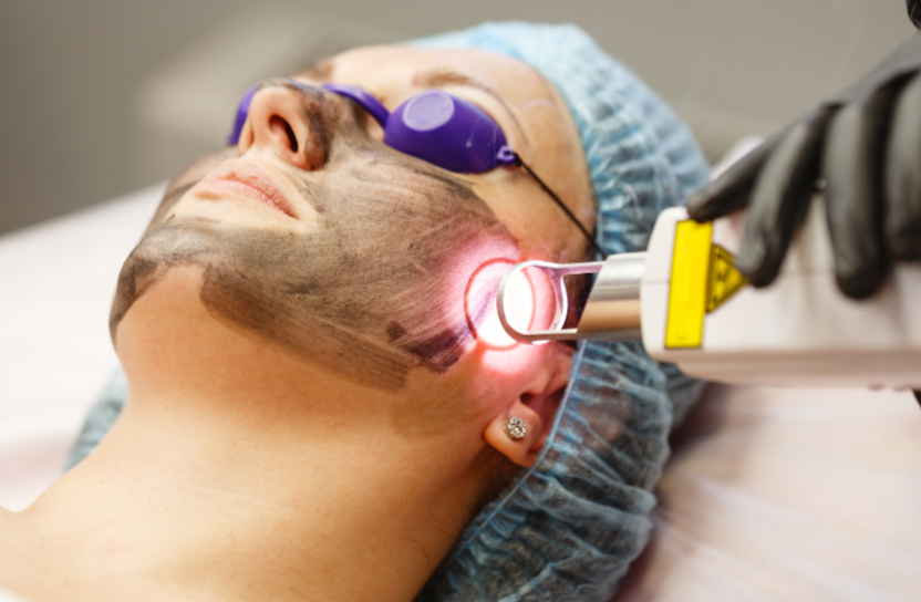 Carbon Laser Facial