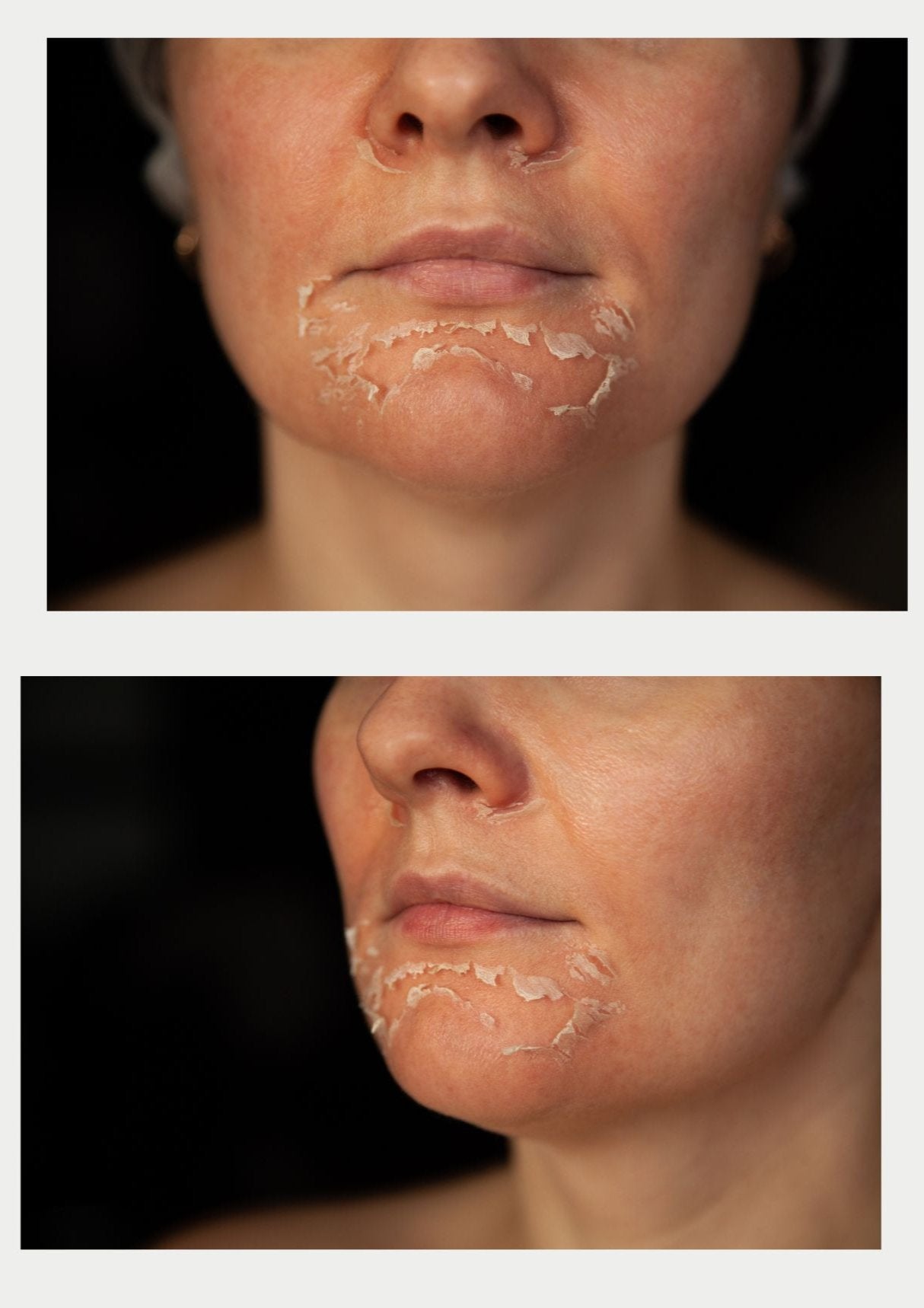 TCA Chemical Peel