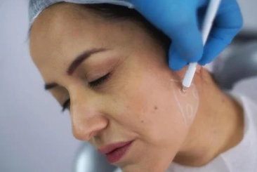 Jawline Filler