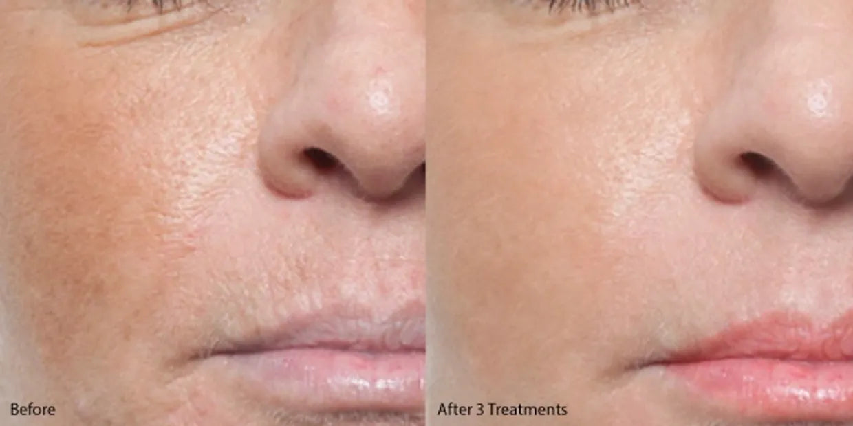 Microneedling w/Exosomes