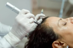 Hair Microneedling w/Exosomes